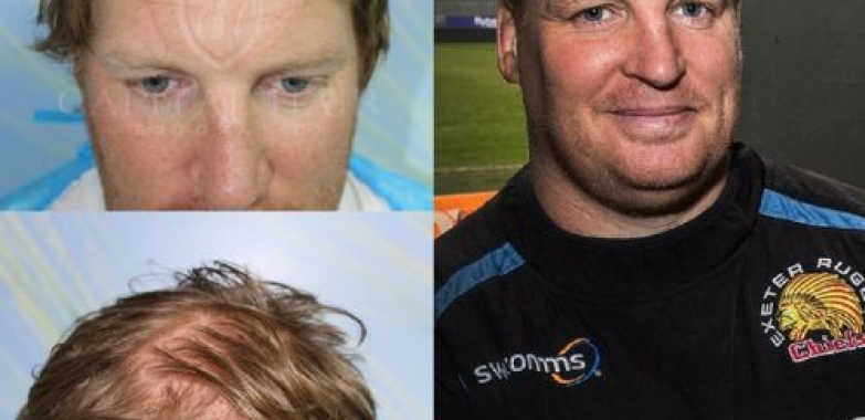 Harley Street Hair Transplant Clinic | Capital Hair Restoration