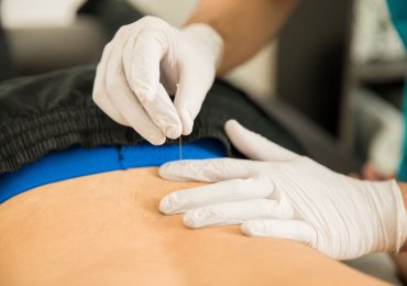 Dry Needling Therapy NYC