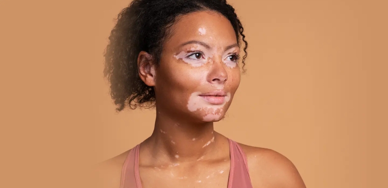 Best Home Remedies for Vitiligo Diseases
