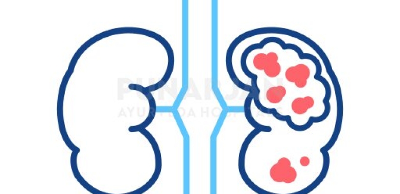 Best Kidney Cancer Treatment Hospitals in Hyderabad
