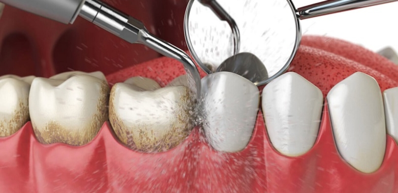 Emergency Dentist Midtown
