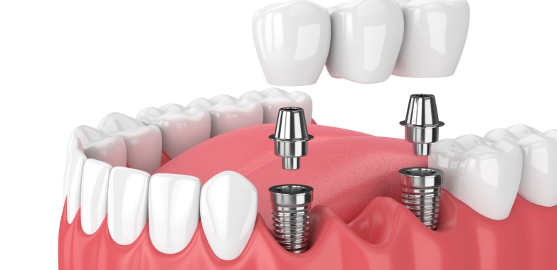 Emergency Dentist Katy Texas