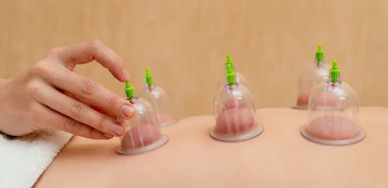 Cupping NYC