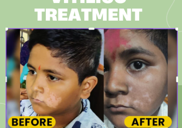 Homeopathic medicine for vitiligo treatment