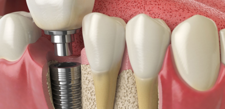 Dental Implants Katy Texas