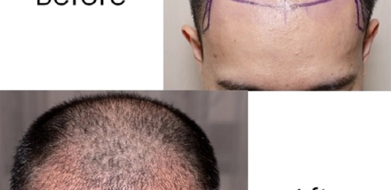 Hair Transplantation Treatment in Chennai