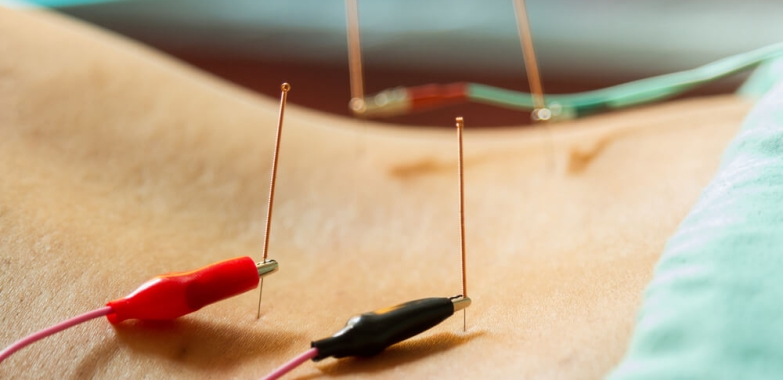 Dry Needling NYC
