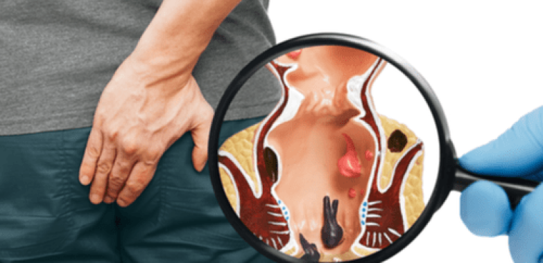 Find Ayurveda Piles Treatment in Indirapuram