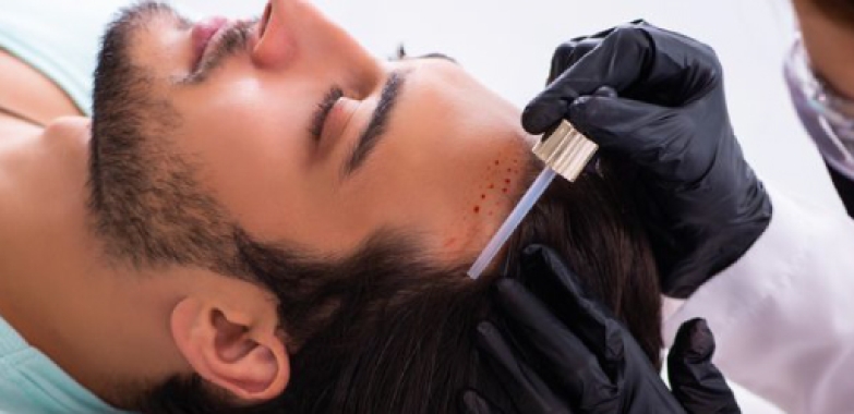 Hair Transplant in New Delhi