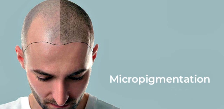 #1 Premiere Scalp Micropigmentation NJ Studio – Hair Micropigmentation – SCALPS
