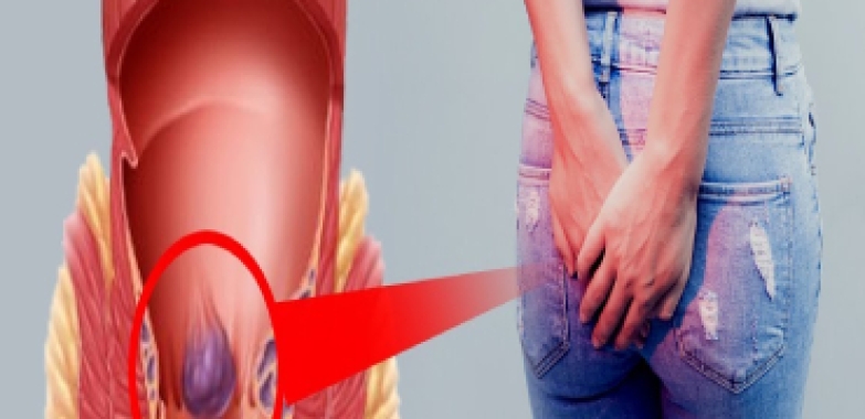 Piles Treatment in Indirapuram with Ayurveda