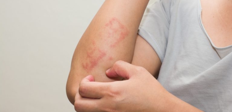 Quadriderm Cream  – Rid Fungal Skin Diseases