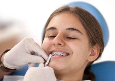 Braces Treatment in Bhopal | Get Straight Teeth with Smile Gallery