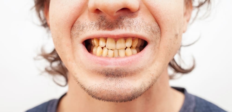 Does Vaping Cause Teeth Stains? Preventing Teeth Stains
