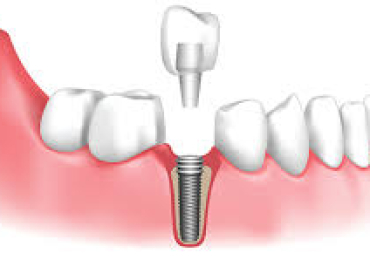 Advanced Dental Implants in Panchsheel Park: Restore Your Smile Today