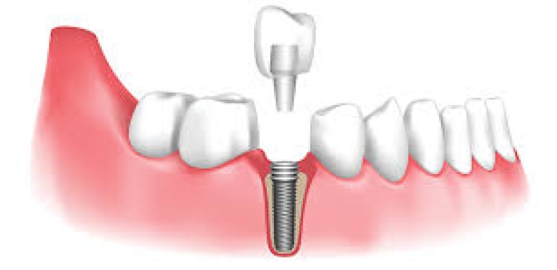 Advanced Dental Implants in Panchsheel Park: Restore Your Smile Today