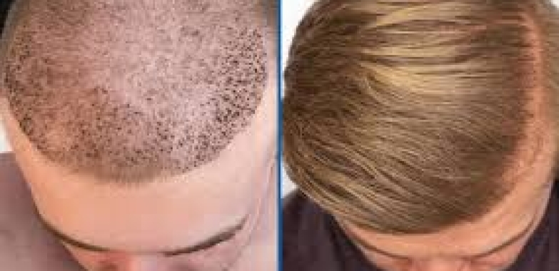 Exploring Different Techniques for Hair Transplant